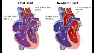 ¿Qué son las cardiopatías congénitas [upl. by Tempest]