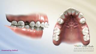 Upper 2nd Bicuspid Extraction  Overjet  Orthodontic Treatment [upl. by Casady]