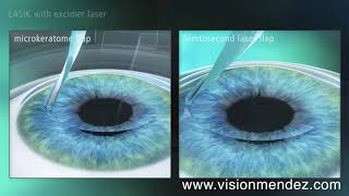 LASIK vs FEMTOLASIK [upl. by Nogaem]