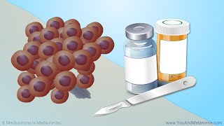 Treating Melanoma [upl. by Teddy414]