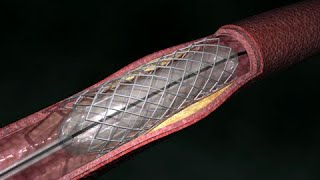 Coronary Artery Angioplasty  Radial Access [upl. by Emma]