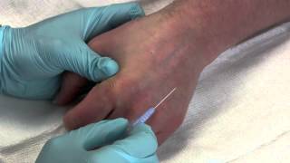 Intravenous Catheter Placement [upl. by Nairrad]