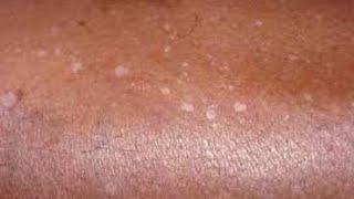 HOW TO TREAT WHITE PATCHES  CAUSES [upl. by Adnilim]