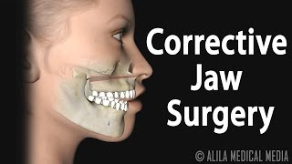 Corrective Jaw Orthognathic Surgery Animation [upl. by Kling]