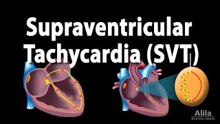 Supraventricular Tachycardia SVT PSVT Animation [upl. by Lunt725]