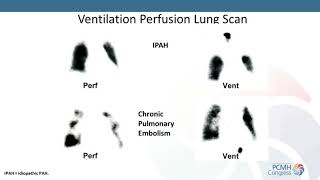 What is Persistent Pulmonary Hypertension of the Newborn [upl. by Ardnossak474]