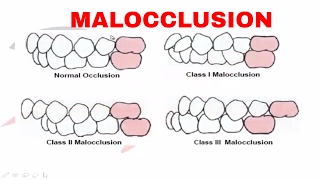 Malocclusion  Part I [upl. by Lotty]