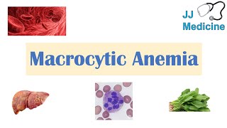 Macrocytic Anemia  Megaloblastic vs NonMegaloblastic  Approach amp Causes [upl. by Kcire]