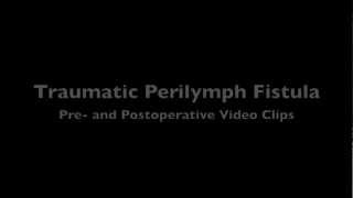 Perilymph Fistula [upl. by Fayette]