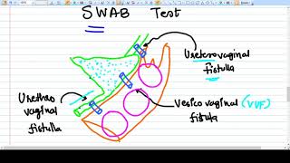 First time Cannulation of AV Fistula [upl. by Diahann]