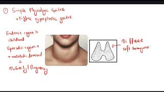 Simple Goitre  Thyroid [upl. by Ernald]