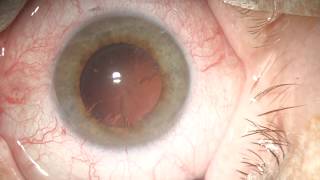 Floppy Iris Syndrome Cataract Surgery [upl. by Galvin609]