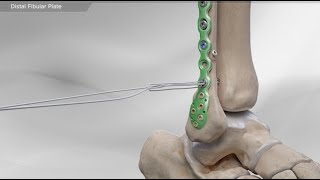 Distal Fibular Plate [upl. by Sidwel943]