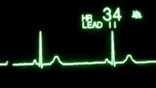 Sinus Bradycardia [upl. by Ocsirf]