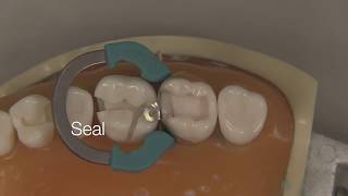 Class II Composite Restoration  Stevenson Dental Solutions [upl. by Limay]