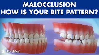 Malocclusion  Bite patterns © [upl. by Odarbil]