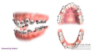 4 Second Bicuspid Extraction  Orthodontic Treatment [upl. by Tracee]