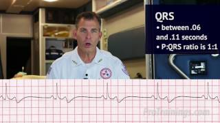 Bradycardia ECG Rhythm Interpretation [upl. by Powell824]