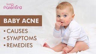 Baby Acne – Causes Symptoms amp Treatment [upl. by Nylodnewg]