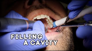 How Does A Dentist Fill A Cavity [upl. by Cochran]