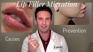 Lip Filler Migration Causes amp Prevention [upl. by Arba]