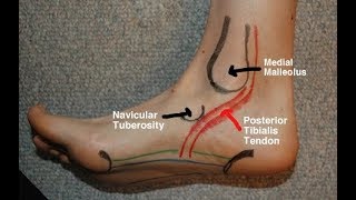 Posterior Tibial Tendinitis Evaluation with Paul Marquis PT [upl. by Spencer240]