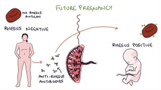 Understanding Rhesus Status and AntiD in Pregnancy [upl. by Aisnetroh623]