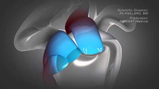 Shoulder Arthroscopy  Rotator Cuff Repair [upl. by Fulvi]