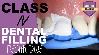 Class IV Composite Filling Tutorial  Front Tooth Filling [upl. by Illil]