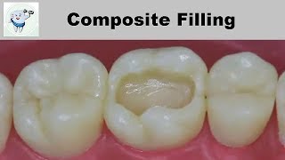 Composite Dental Filling Step by Step [upl. by Cantu976]