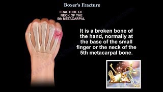 Boxers Fracture  Everything You Need To Know  Dr Nabil Ebraheim [upl. by Mcdade23]