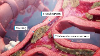 What Is Severe Asthma [upl. by Meghan957]