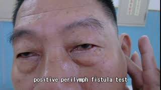 Positive perilymph fistula test [upl. by Alisun]