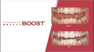 StepbyStep Opalescence Boost Teeth Whitening Procedure  Australia [upl. by Arriec]