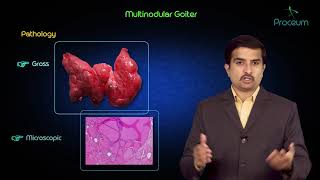 Multinodular goitre  Usmle step 1 pathology lecture and case presentation [upl. by Flannery]