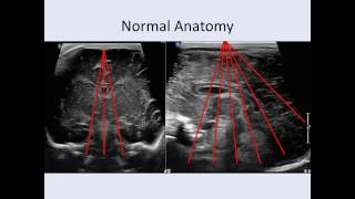 Cranial Ultrasound Anatomy [upl. by Ludeman]