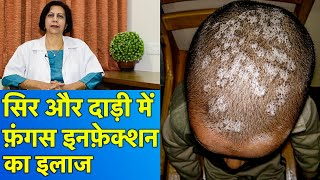 सिर और दाड़ी के फ़ंगस इनफ़ेक्शन का इलाज  Treatment of Fungal Infections In Beard amp Scalp [upl. by Mcgaw]