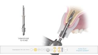 IStent  Cypass Microstent Xen 45 Gel Stent Cataract Surgery [upl. by Catrina654]