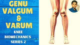 GENU VALGUM amp GENU VARUM  Knee Complex Biomechanics [upl. by Keefe219]