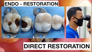 Dental Filling Procedure from Endodontic to Restoration Composite  General Dentist Griya RR [upl. by Anselme]