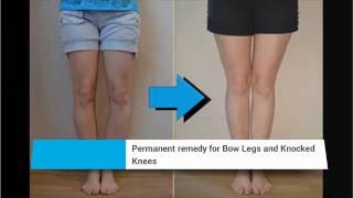 How To Treat Your Bowed Legs Naturally [upl. by Ehsrop908]